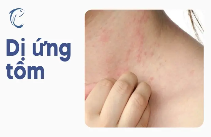 Mức độ nguy hiểm của dị ứng tôm và cách xử lý kịp thời